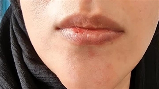 تزریق فیلر لب در کلینیک دکتر میرزایی