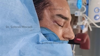 رفع الحاجب بالمنظار للرجال