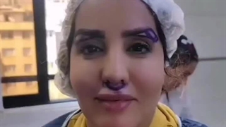 تکنیک جدید عمل بلفاروپلاستی پلک و دایرکت ابرو  با بخیه زیبایی