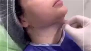 رفع غبغب با لیپوساکشن: راهکاری سریع و موثر