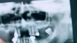 ایمپلنت-به-دندون-وصل-نمیشه نهایی