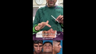 جراحی بینی مردانه