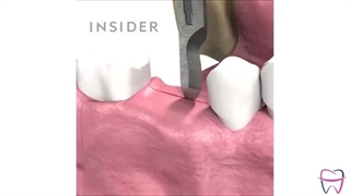 ایمپلنت دندان چگونه انجام می شود