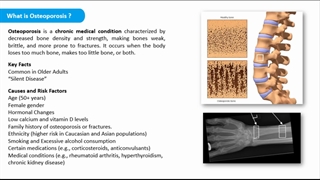 استئوپورز (پوکی استخوان) چیست؟ | بیماری خاموش و خطرناک