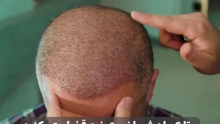 کلینیک کاشت مو و ابرو اورامان