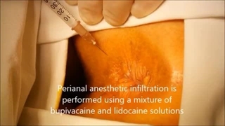 فیلم عمل جراحی شقاق مقعدی