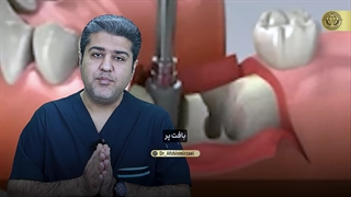 ایمپلنت به روش پانچ چیست؟