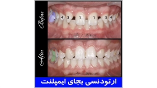 ارتودنسی به جای ایمپلنت