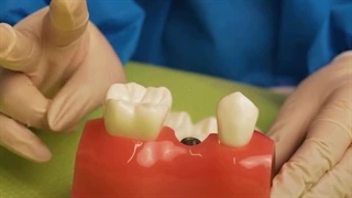 تفاوت بریج با ایمپلنت برای جایگزینی دندان