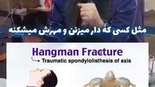 شکستگی مهره‌های اول و دوم گردن