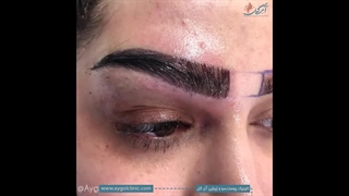 ابروهای پرپشت و طبیعی با جدیدترین تکنیک کاشت!