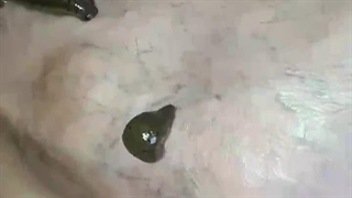 گزش دقیق زالو در درمان |صنعت زالو ایران