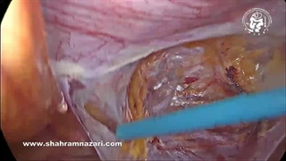 جراحی لاپاروسکوپی ترمیم فتق کشاله ران سمت راست