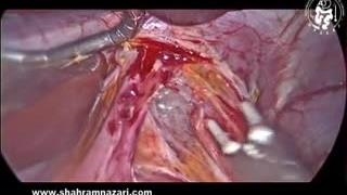 فوندوپلیکاسیون نیسن در درمان ریفلاکس