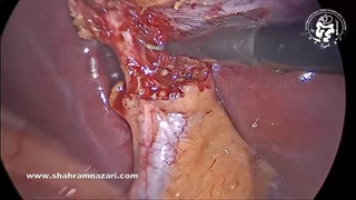 دو ساختار و فقط دو ساختار باید در حال ورود به کیسه صفرا دیده شوند.