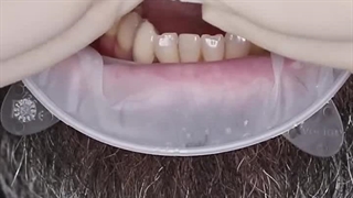 تحویل روکش ایمپلنت