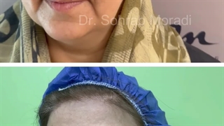 رفع الحاجب بالمنظار وجراحة الجفن العلوی