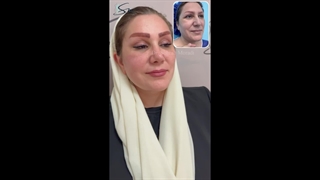 قبل وبعد، حقا؟ جراحة شد الوجه