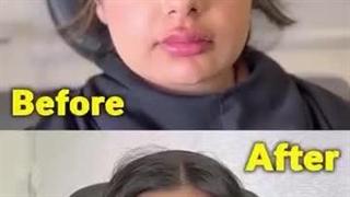 بوتاکس در کلینیک ماهرخ