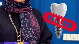 دلیل نگرفتن ایمپلنت