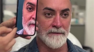 دکتر محمد مسعودی بوتاکس لیفت پیشانی