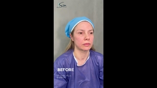 لیفت عمقی صورت و گردن | مراجعه کننده از انگلستان