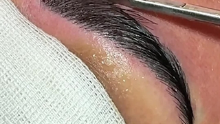 نحوه کاشت موهای ابرو در کلینیک مانا