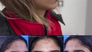 جراحی بینی در سعادت آباد