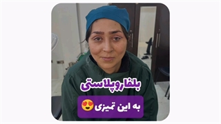 هزینه عمل بلفاروپلاستی در مشهد