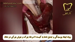 پوسیدگی دندان و تبدیل شدن به کیست