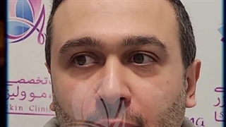 کاشت مو در کلینیک آوینا