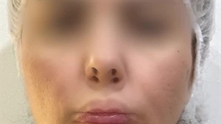 لیفت با نخ آپتوس - دکتر علی پرتوی نژاد برداشتن خال گوشتی