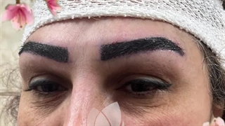 کاشت ابرو در کلینیک آوینا