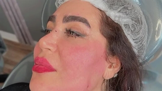 لیفت صورت با نخ در تهران با دکتر محمد یوسفوند