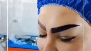 کاشت مو و ابرو آهو در شیراز