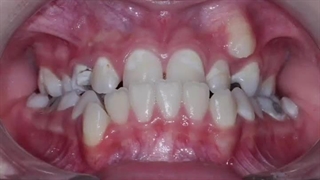 اصلاح جلو آمدگی فک بالا بدون جراحی