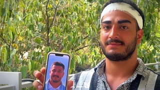 کاشت ابرو مردانه کلینیک لاله