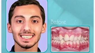 بیفور افتر بی نظیر