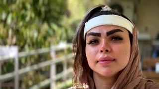 میکروکاشت ابرو کلینیک لاله