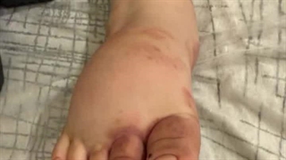 درمان لنف ادم اولیه