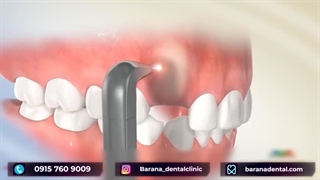 درمان دندان نیش نهفته با ارتودنسی