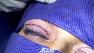 فیلم عمل بلفاروپلاستی لیزری کلینیک لاله