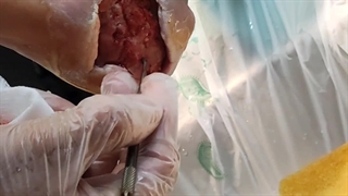 آموزش استفاده از کورت (متمم_زخم) 2