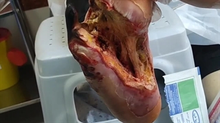 آموزش کوتر زخم (متمم_زخم) 1