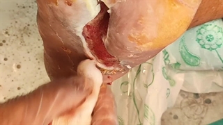 آموزش نحوه بروساژ زخم (متمم_زخم)