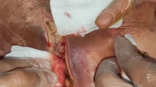 آموزش نحوه میلک کردن زخم (متمم_زخم)