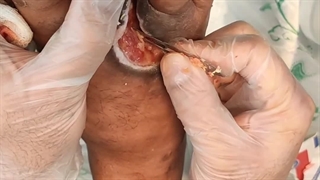 آموزش نحوه پاکسازی کراست زخم (متمم_زخم)