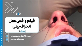 عمل انحراف بینی (سپتوپلاستی) - پزشک 24