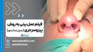 فیلم واقعی جراحی بینی به روش پیزوسرجری - پزشک 24