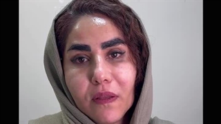 رضایت مراجعه کننده عزیز از تزریق چربی+بلفارو+کاشت ابرو+prf